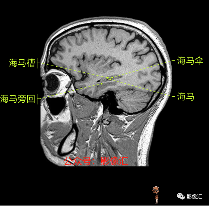影像PPT - 脑边缘叶MR解剖标记-190