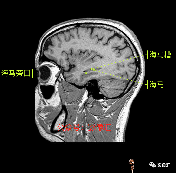 影像PPT - 脑边缘叶MR解剖标记-191