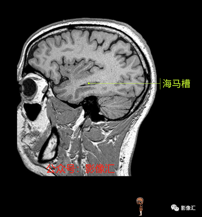 影像PPT - 脑边缘叶MR解剖标记-192