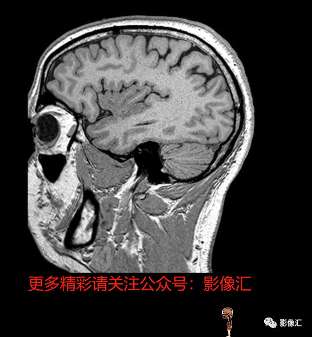 影像PPT - 脑边缘叶MR解剖标记-193