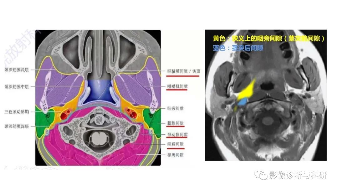 影像PPT - 咽旁间隙解剖定位及对应好发肿瘤-2 影像PPT - 咽旁间隙解剖定位及对应好发肿瘤-2