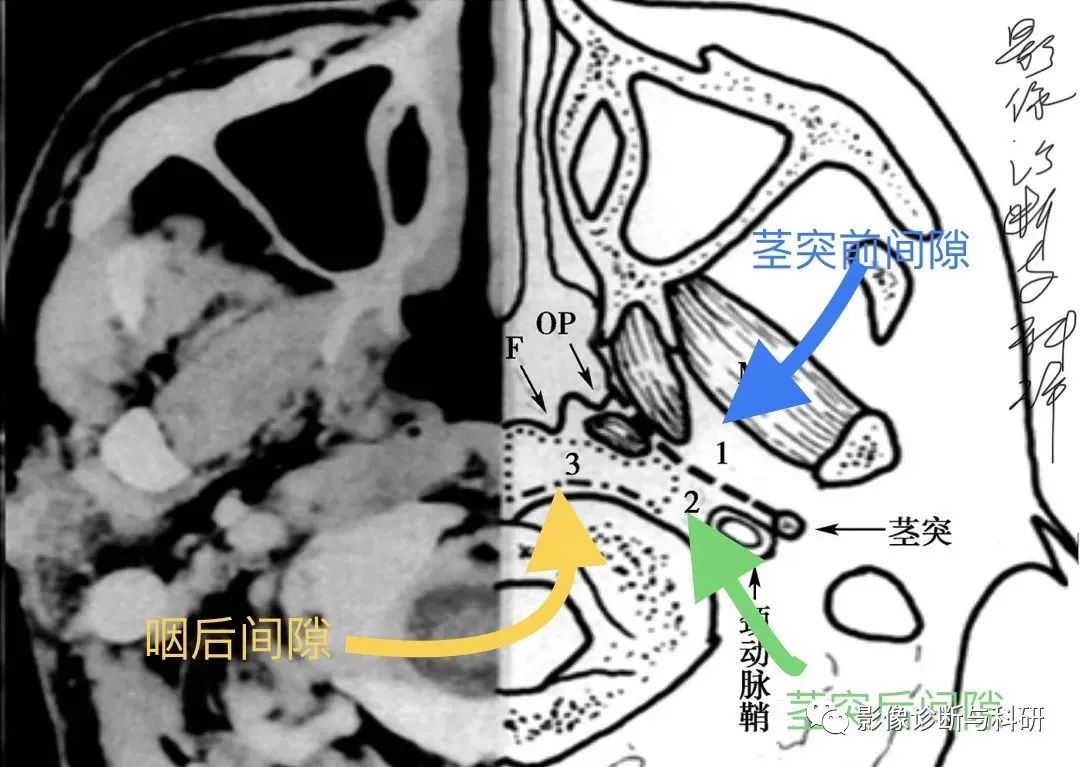 影像PPT - 咽旁间隙解剖定位及对应好发肿瘤-1 影像PPT - 咽旁间隙解剖定位及对应好发肿瘤-1