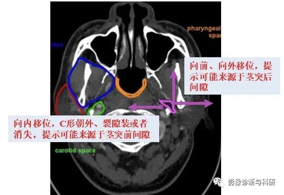 影像PPT - 咽旁间隙解剖定位及对应好发肿瘤-4 影像PPT - 咽旁间隙解剖定位及对应好发肿瘤-4