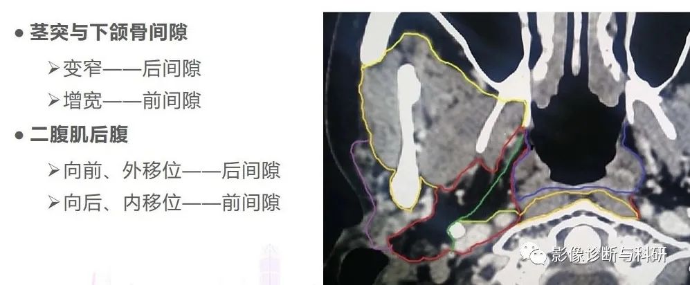 影像PPT - 咽旁间隙解剖定位及对应好发肿瘤-3 影像PPT - 咽旁间隙解剖定位及对应好发肿瘤-3