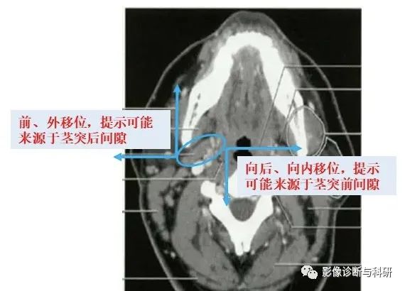影像PPT - 咽旁间隙解剖定位及对应好发肿瘤-5 影像PPT - 咽旁间隙解剖定位及对应好发肿瘤-5