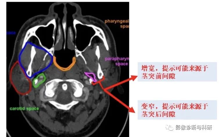 影像PPT - 咽旁间隙解剖定位及对应好发肿瘤-7 影像PPT - 咽旁间隙解剖定位及对应好发肿瘤-7