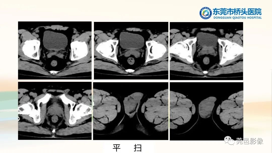 影像PPT - 【PPT】生殖系统结核一例分享-3