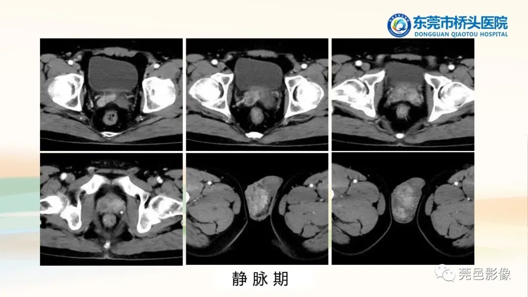 影像PPT - 【PPT】生殖系统结核一例分享-5