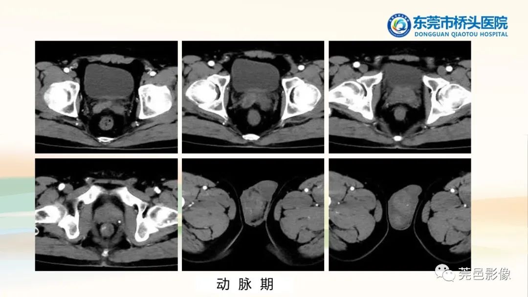 影像PPT - 【PPT】生殖系统结核一例分享-4
