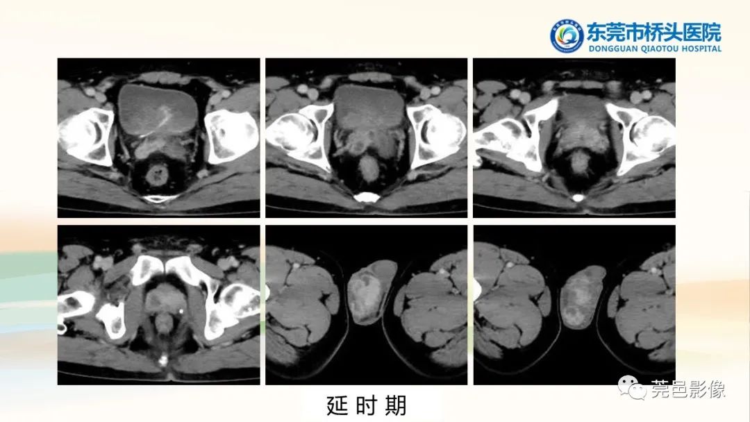 影像PPT - 【PPT】生殖系统结核一例分享-6