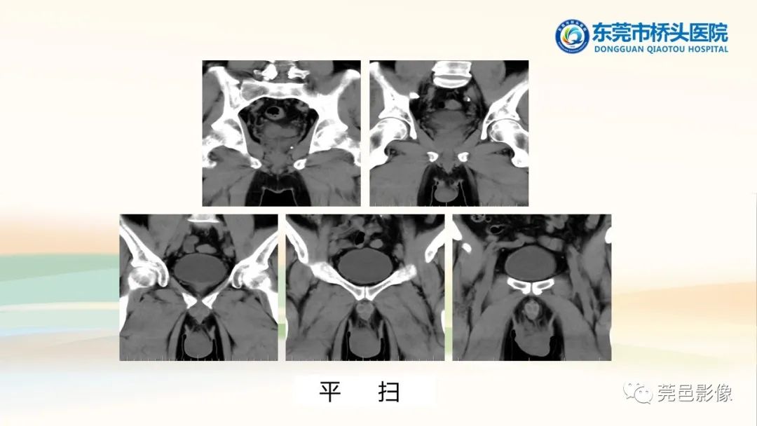 影像PPT - 【PPT】生殖系统结核一例分享-7