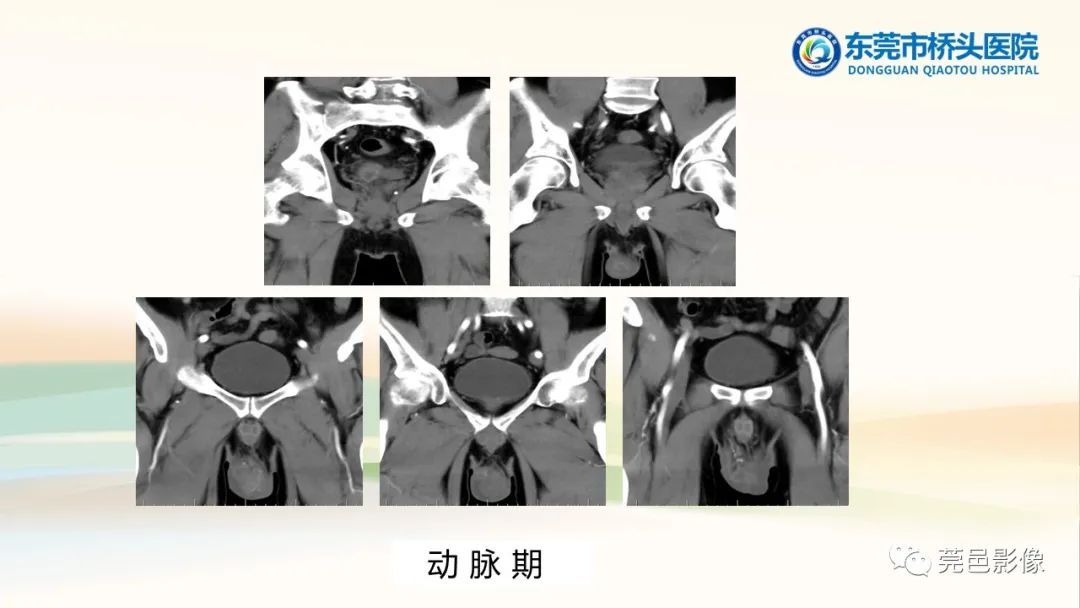 影像PPT - 【PPT】生殖系统结核一例分享-8