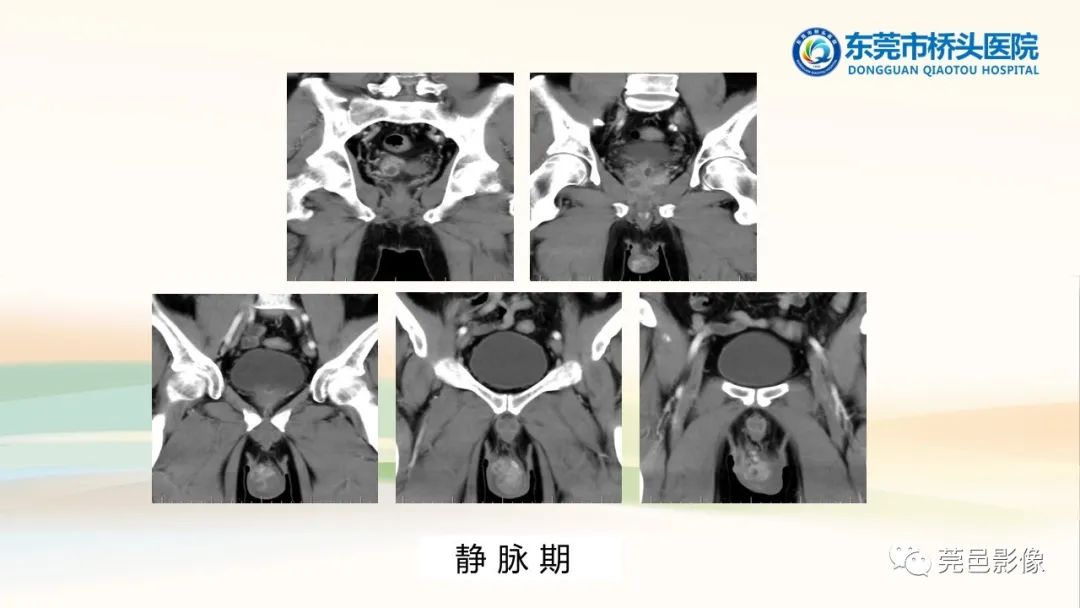 影像PPT - 【PPT】生殖系统结核一例分享-9