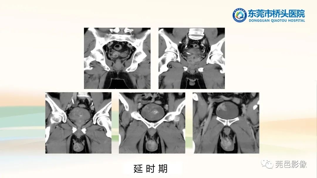 影像PPT - 【PPT】生殖系统结核一例分享-10