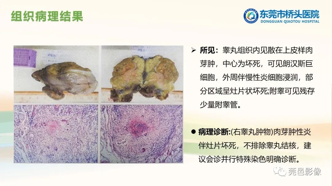 影像PPT - 【PPT】生殖系统结核一例分享-12