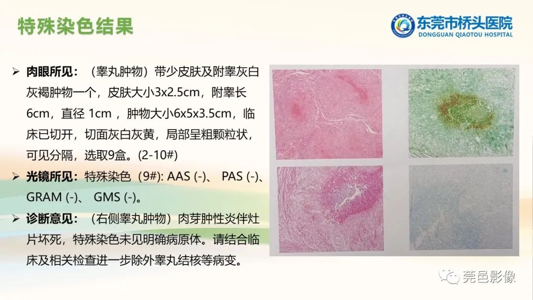 影像PPT - 【PPT】生殖系统结核一例分享-13