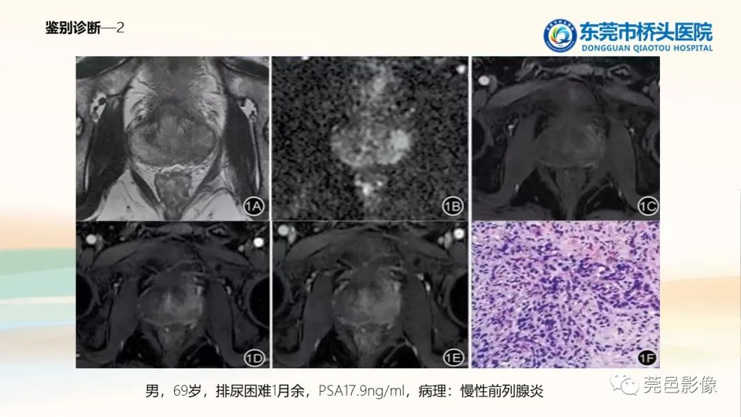 影像PPT - 【PPT】生殖系统结核一例分享-18