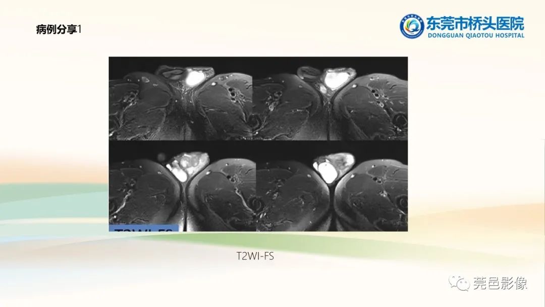 影像PPT - 【PPT】生殖系统结核一例分享-21