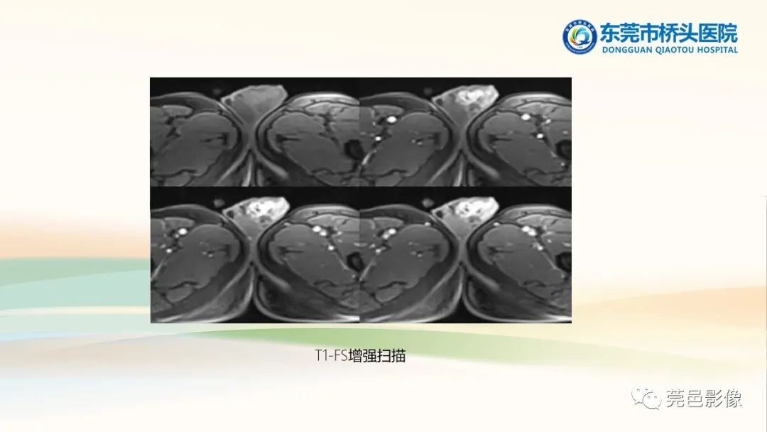影像PPT - 【PPT】生殖系统结核一例分享-24