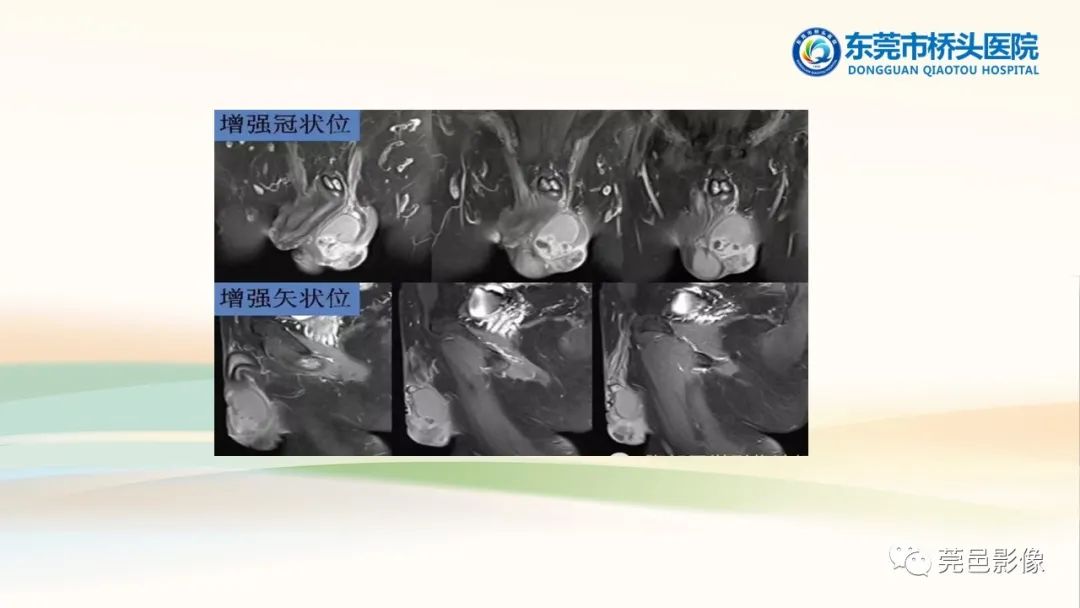影像PPT - 【PPT】生殖系统结核一例分享-25