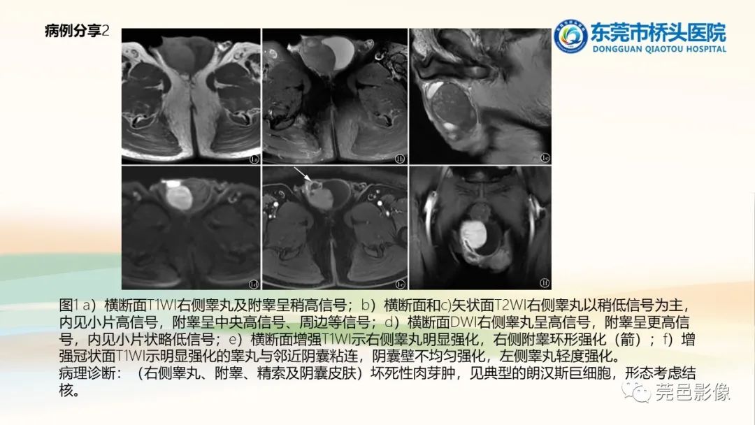 影像PPT - 【PPT】生殖系统结核一例分享-27