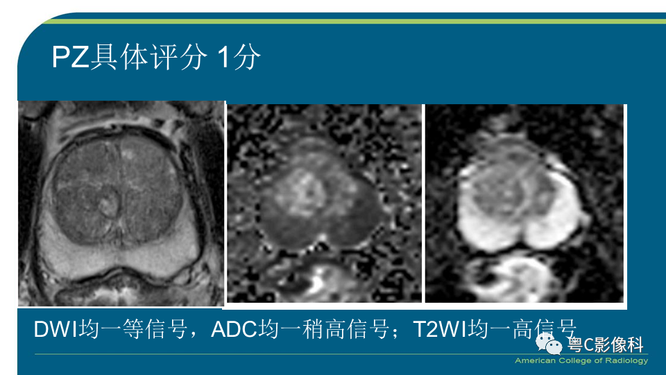 影像PPT - 【PPT】PI-RADS v2.1 修订解读并浅谈临床应用局限性-17 影像PPT - 【PPT】PI-RADS v2.1 修订解读并浅谈临床应用局限性-17
