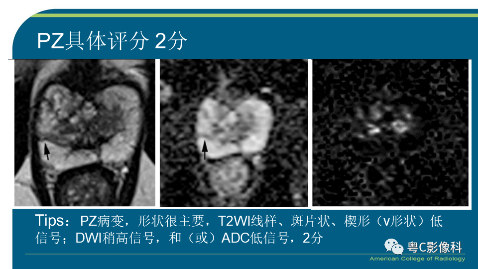影像PPT - 【PPT】PI-RADS v2.1 修订解读并浅谈临床应用局限性-18 影像PPT - 【PPT】PI-RADS v2.1 修订解读并浅谈临床应用局限性-18