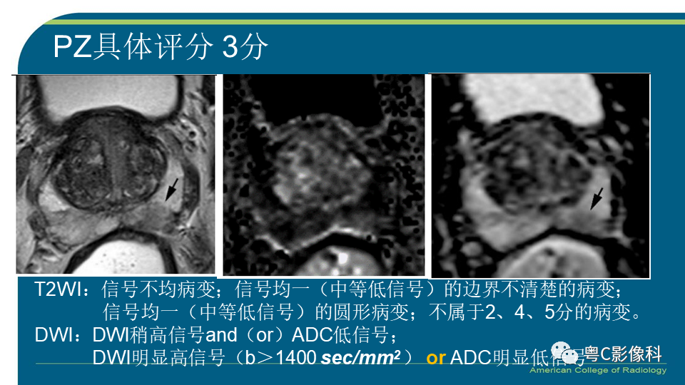 影像PPT - 【PPT】PI-RADS v2.1 修订解读并浅谈临床应用局限性-19 影像PPT - 【PPT】PI-RADS v2.1 修订解读并浅谈临床应用局限性-19