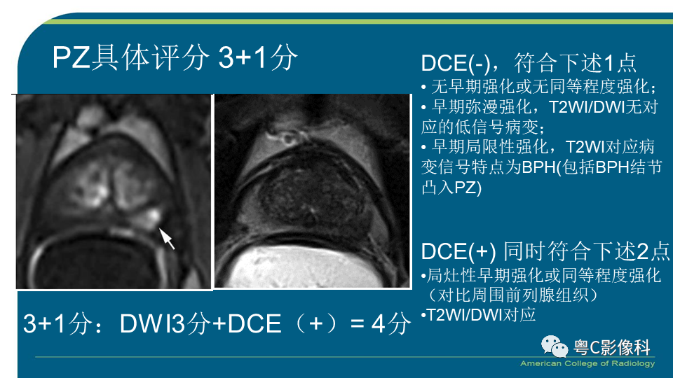 影像PPT - 【PPT】PI-RADS v2.1 修订解读并浅谈临床应用局限性-20 影像PPT - 【PPT】PI-RADS v2.1 修订解读并浅谈临床应用局限性-20