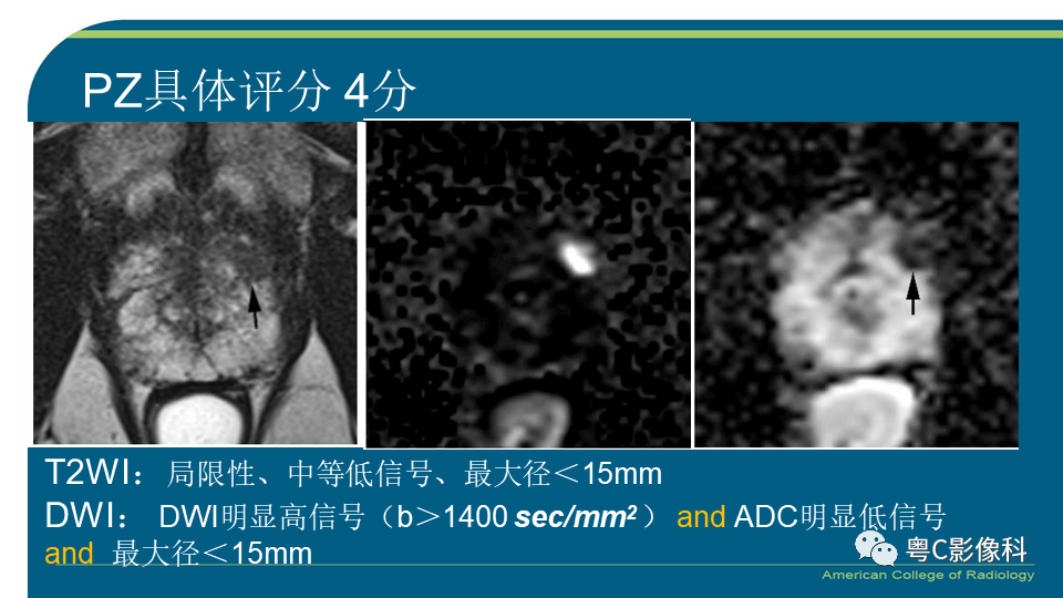 影像PPT - 【PPT】PI-RADS v2.1 修订解读并浅谈临床应用局限性-21 影像PPT - 【PPT】PI-RADS v2.1 修订解读并浅谈临床应用局限性-21