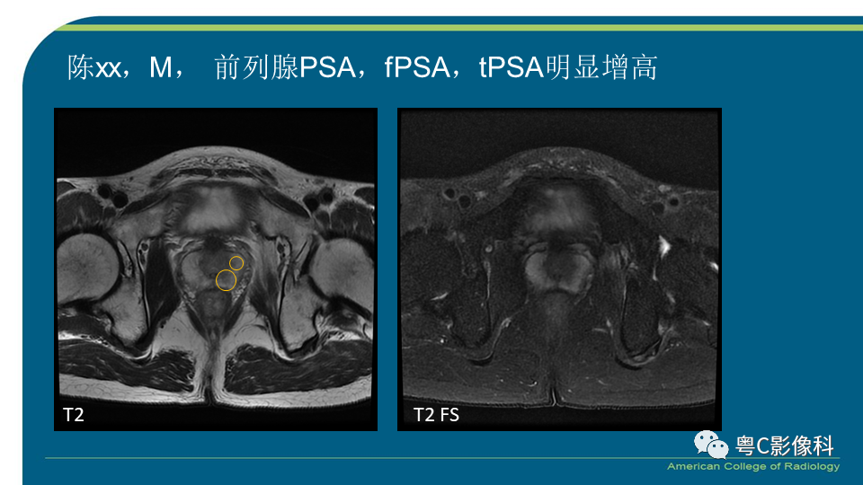 影像PPT - 【PPT】PI-RADS v2.1 修订解读并浅谈临床应用局限性-22 影像PPT - 【PPT】PI-RADS v2.1 修订解读并浅谈临床应用局限性-22