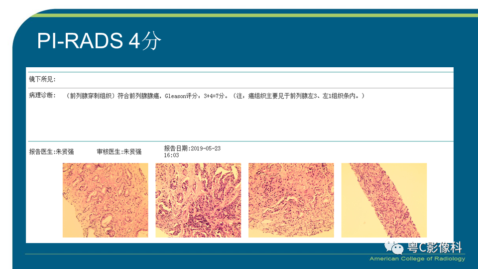 影像PPT - 【PPT】PI-RADS v2.1 修订解读并浅谈临床应用局限性-25 影像PPT - 【PPT】PI-RADS v2.1 修订解读并浅谈临床应用局限性-25