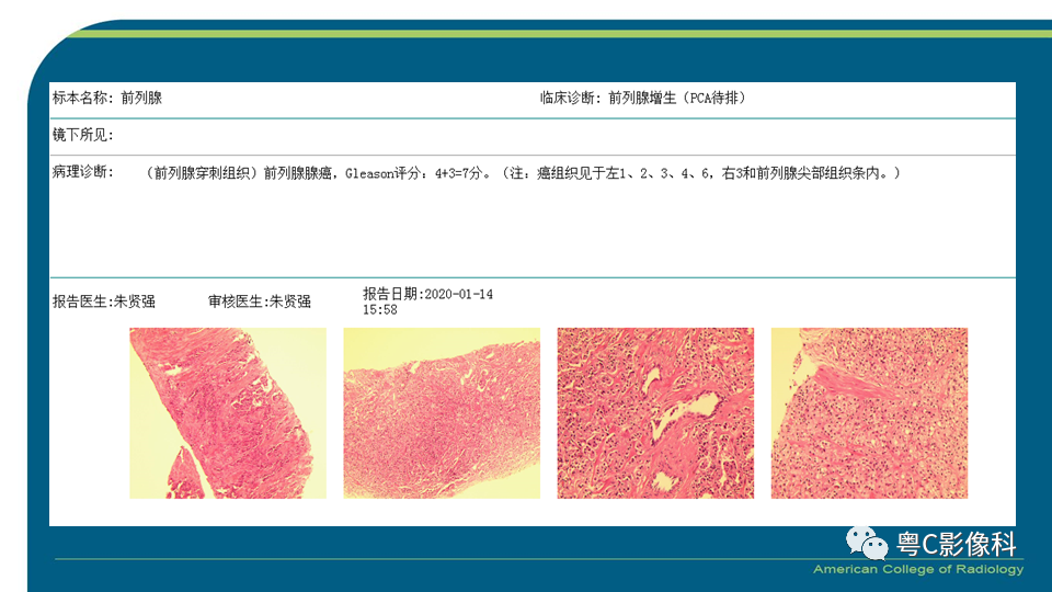 影像PPT - 【PPT】PI-RADS v2.1 修订解读并浅谈临床应用局限性-31 影像PPT - 【PPT】PI-RADS v2.1 修订解读并浅谈临床应用局限性-31