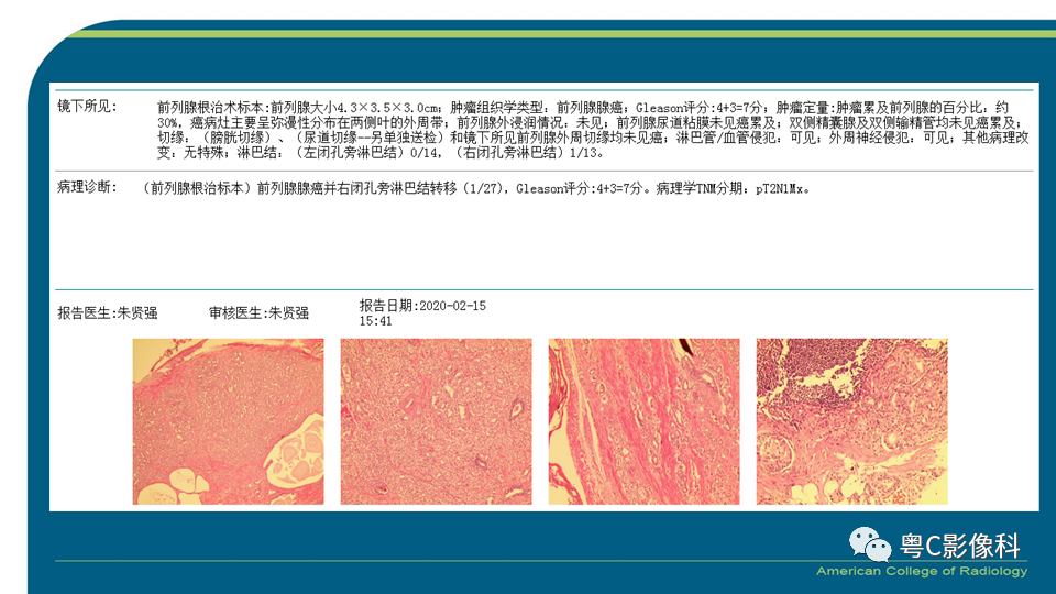 影像PPT - 【PPT】PI-RADS v2.1 修订解读并浅谈临床应用局限性-32 影像PPT - 【PPT】PI-RADS v2.1 修订解读并浅谈临床应用局限性-32