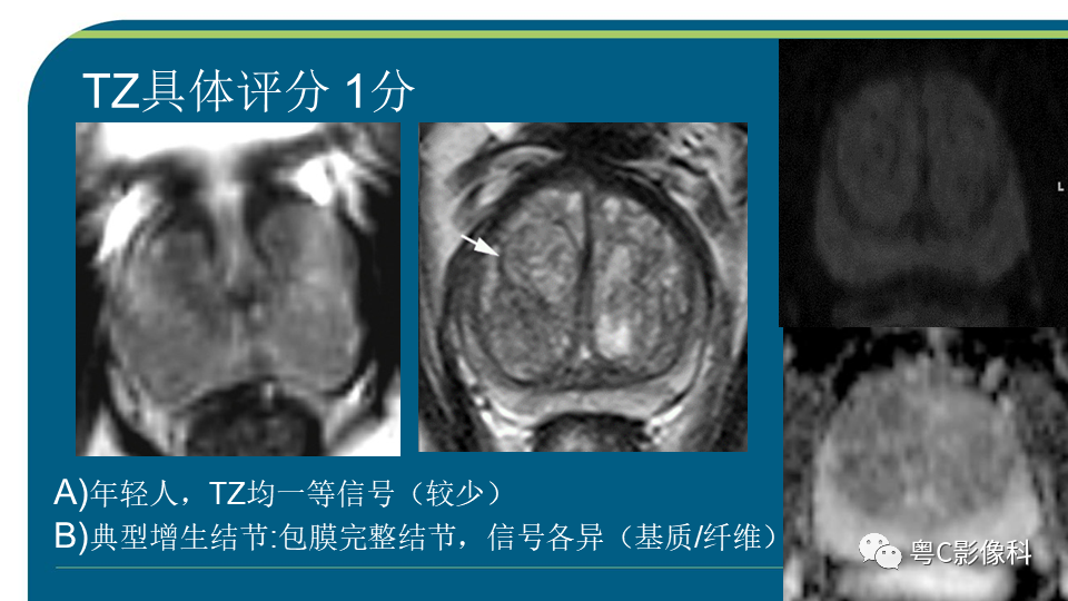影像PPT - 【PPT】PI-RADS v2.1 修订解读并浅谈临床应用局限性-34 影像PPT - 【PPT】PI-RADS v2.1 修订解读并浅谈临床应用局限性-34