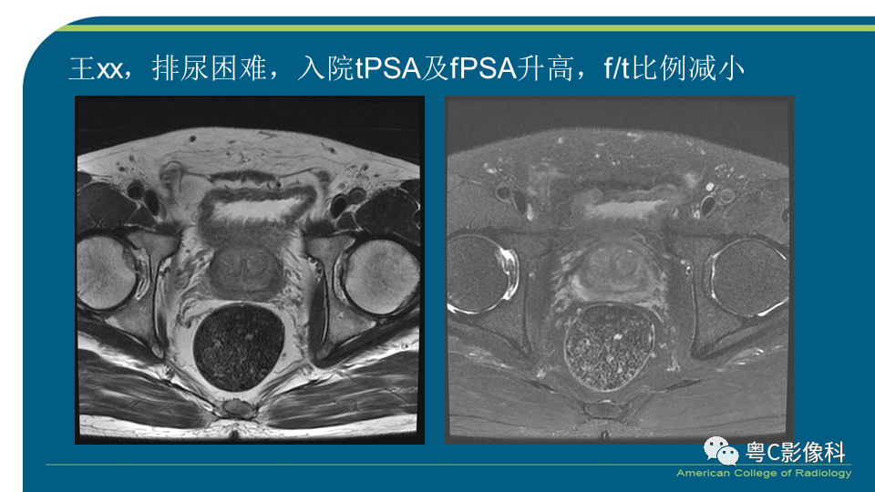 影像PPT - 【PPT】PI-RADS v2.1 修订解读并浅谈临床应用局限性-35 影像PPT - 【PPT】PI-RADS v2.1 修订解读并浅谈临床应用局限性-35