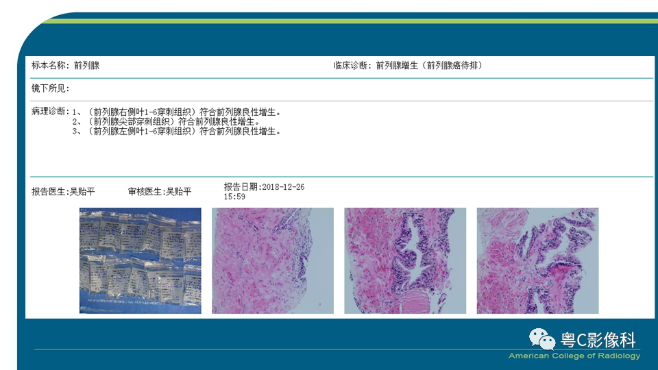 影像PPT - 【PPT】PI-RADS v2.1 修订解读并浅谈临床应用局限性-38 影像PPT - 【PPT】PI-RADS v2.1 修订解读并浅谈临床应用局限性-38