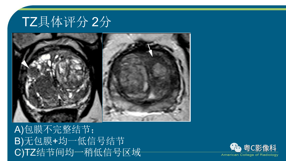 影像PPT - 【PPT】PI-RADS v2.1 修订解读并浅谈临床应用局限性-39 影像PPT - 【PPT】PI-RADS v2.1 修订解读并浅谈临床应用局限性-39