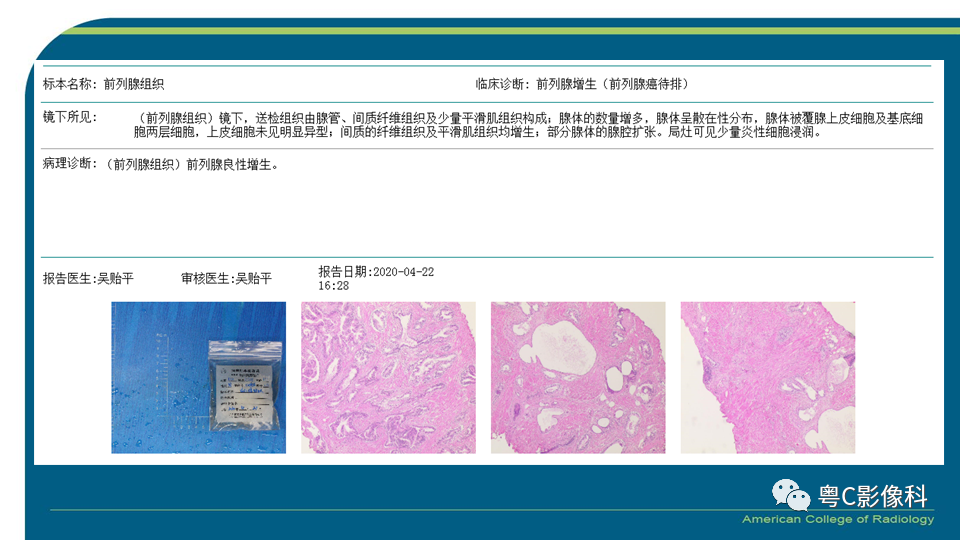 影像PPT - 【PPT】PI-RADS v2.1 修订解读并浅谈临床应用局限性-42 影像PPT - 【PPT】PI-RADS v2.1 修订解读并浅谈临床应用局限性-42