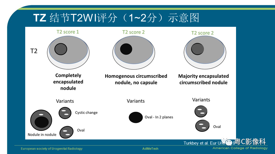 影像PPT - 【PPT】PI-RADS v2.1 修订解读并浅谈临床应用局限性-40 影像PPT - 【PPT】PI-RADS v2.1 修订解读并浅谈临床应用局限性-40