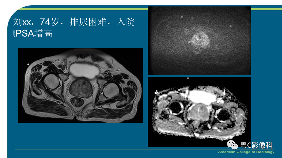影像PPT - 【PPT】PI-RADS v2.1 修订解读并浅谈临床应用局限性-41 影像PPT - 【PPT】PI-RADS v2.1 修订解读并浅谈临床应用局限性-41