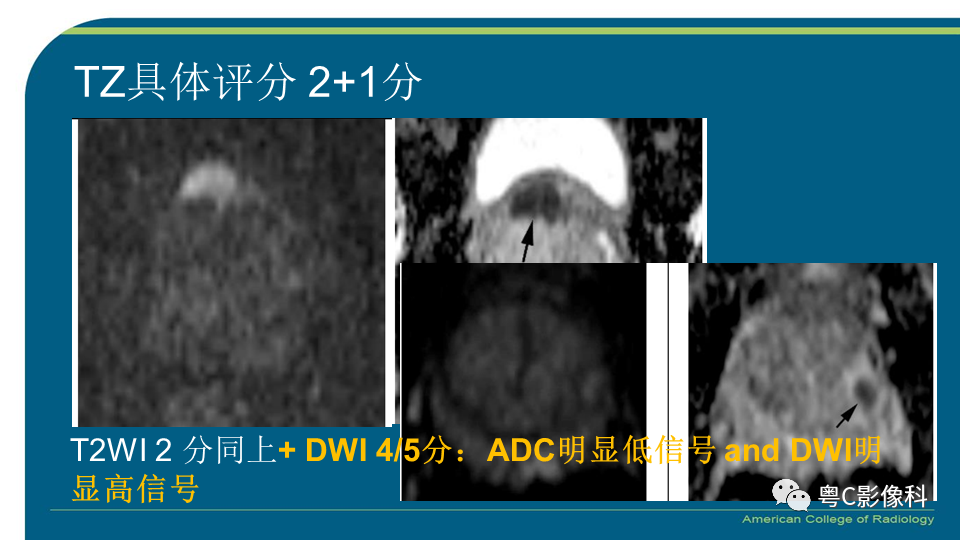 影像PPT - 【PPT】PI-RADS v2.1 修订解读并浅谈临床应用局限性-43 影像PPT - 【PPT】PI-RADS v2.1 修订解读并浅谈临床应用局限性-43