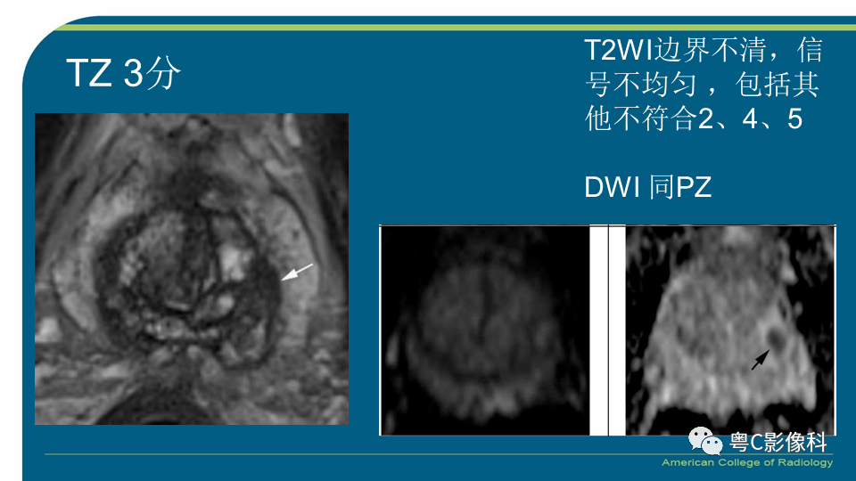 影像PPT - 【PPT】PI-RADS v2.1 修订解读并浅谈临床应用局限性-44 影像PPT - 【PPT】PI-RADS v2.1 修订解读并浅谈临床应用局限性-44