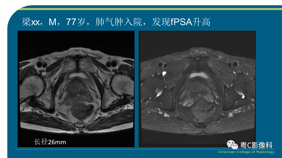 影像PPT - 【PPT】PI-RADS v2.1 修订解读并浅谈临床应用局限性-48 影像PPT - 【PPT】PI-RADS v2.1 修订解读并浅谈临床应用局限性-48