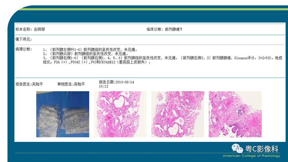 影像PPT - 【PPT】PI-RADS v2.1 修订解读并浅谈临床应用局限性-51 影像PPT - 【PPT】PI-RADS v2.1 修订解读并浅谈临床应用局限性-51