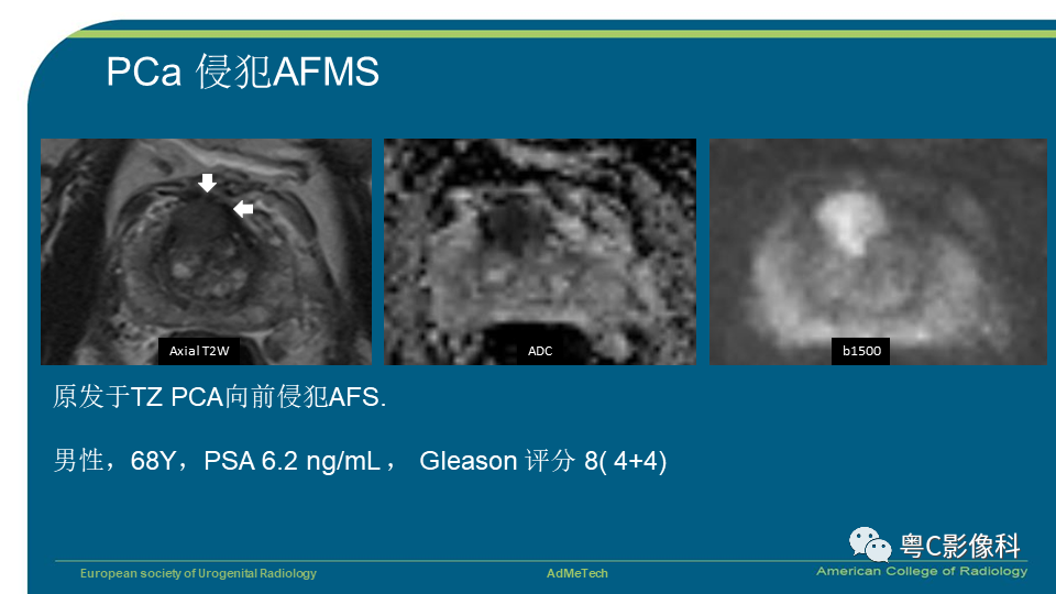 影像PPT - 【PPT】PI-RADS v2.1 修订解读并浅谈临床应用局限性-53 影像PPT - 【PPT】PI-RADS v2.1 修订解读并浅谈临床应用局限性-53