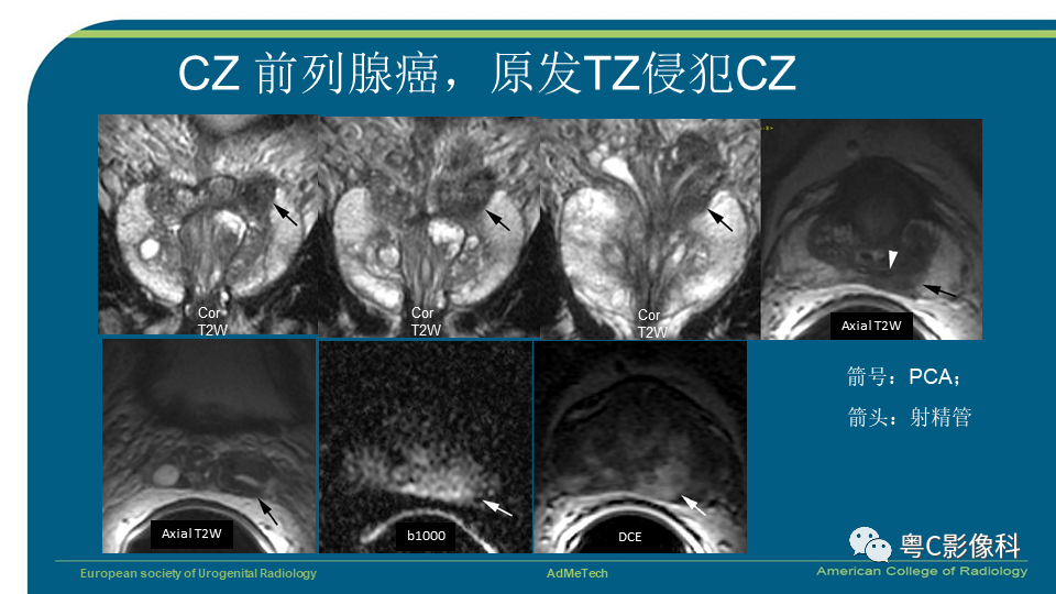 影像PPT - 【PPT】PI-RADS v2.1 修订解读并浅谈临床应用局限性-54 影像PPT - 【PPT】PI-RADS v2.1 修订解读并浅谈临床应用局限性-54
