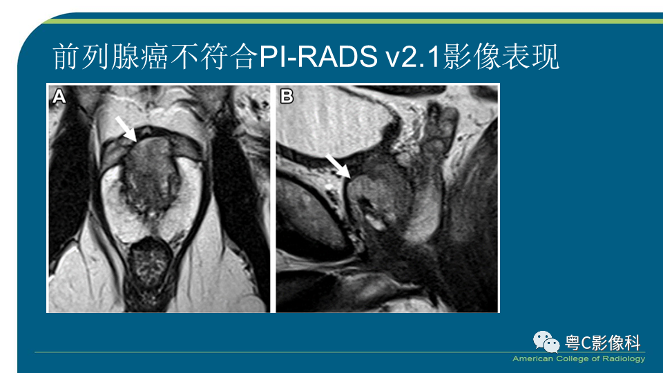 影像PPT - 【PPT】PI-RADS v2.1 修订解读并浅谈临床应用局限性-57 影像PPT - 【PPT】PI-RADS v2.1 修订解读并浅谈临床应用局限性-57