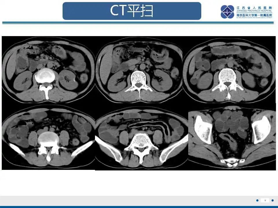 影像PPT - 【PPT】溃疡性结肠炎-3
