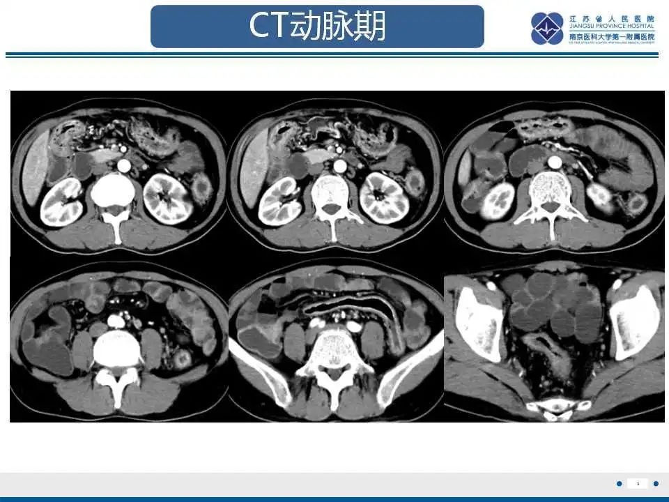 影像PPT - 【PPT】溃疡性结肠炎-4